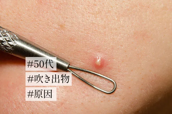 50代でできる吹き出物・ニキビの原因5つ！効果的な対処法も解説！
