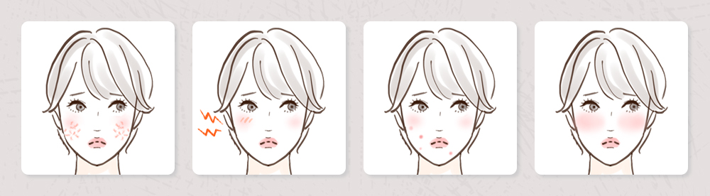 更年期に起こりやすい肌荒れの例