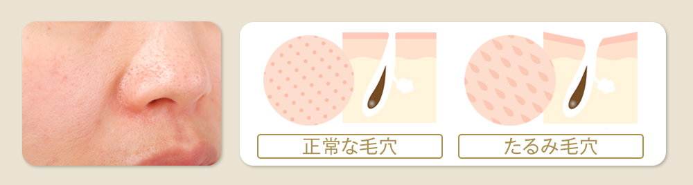 たるみ毛穴とは？